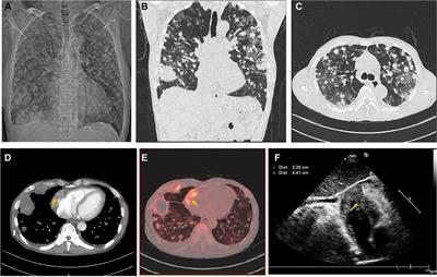 Intracardiac biopsy of cardiac tumors with echocardiographic guidance: Case report
